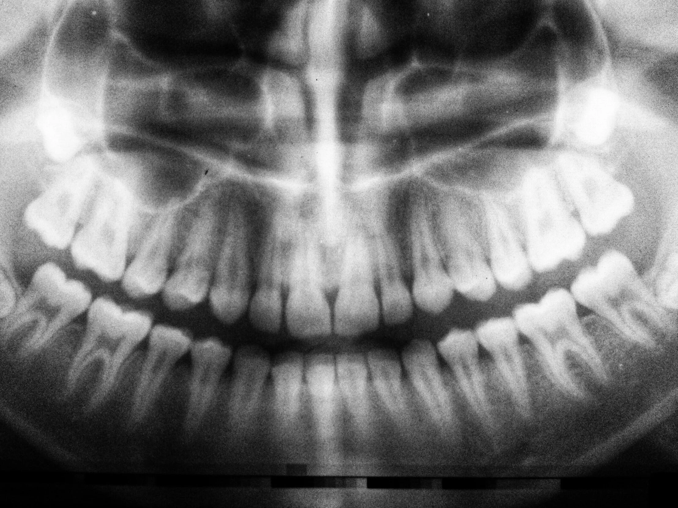 Dental X-Ray